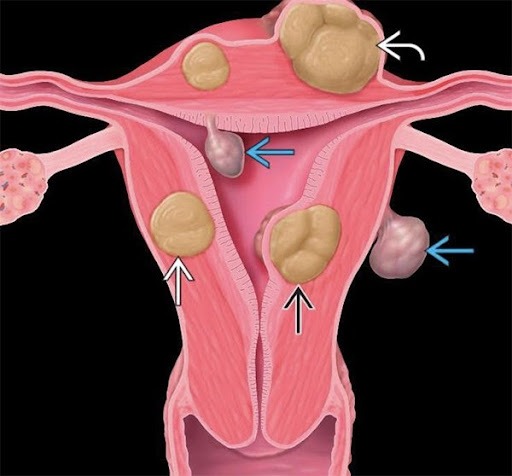 U xơ tử cung – Bệnh phụ khoa phổ biến ở nữ giới